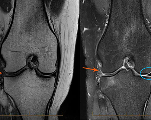 knee_r knee_r